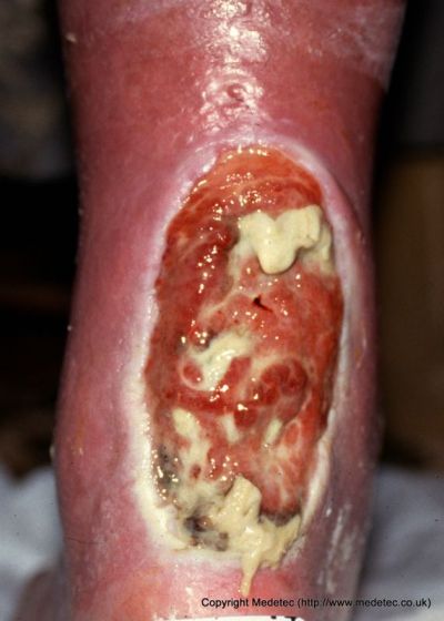 leg ulcer